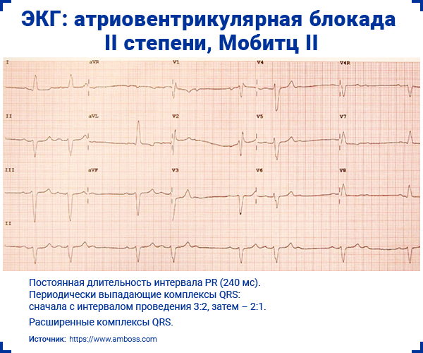 ЭКГ атриовентрикулярная блокада II степени, Мобитц II